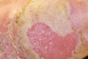 مزایای ترمیم زخم به روش مرطوب