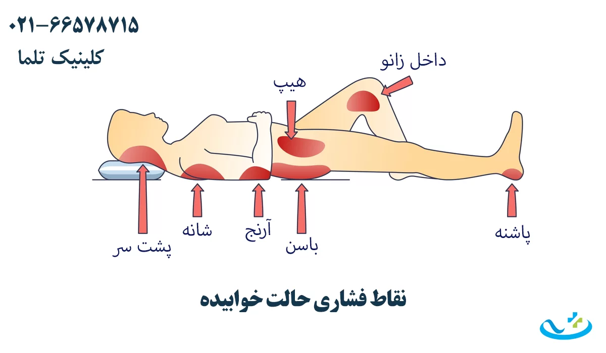 نقاط فشاری زخم بستر