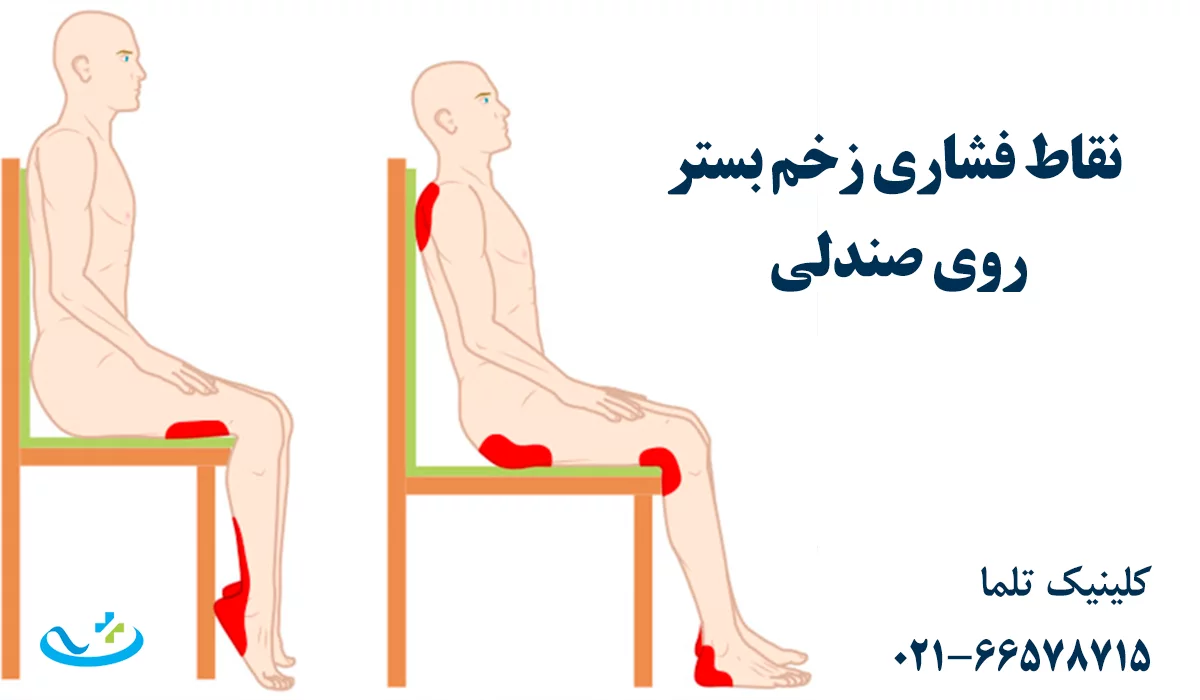 نقاط فشاری زخم بستر