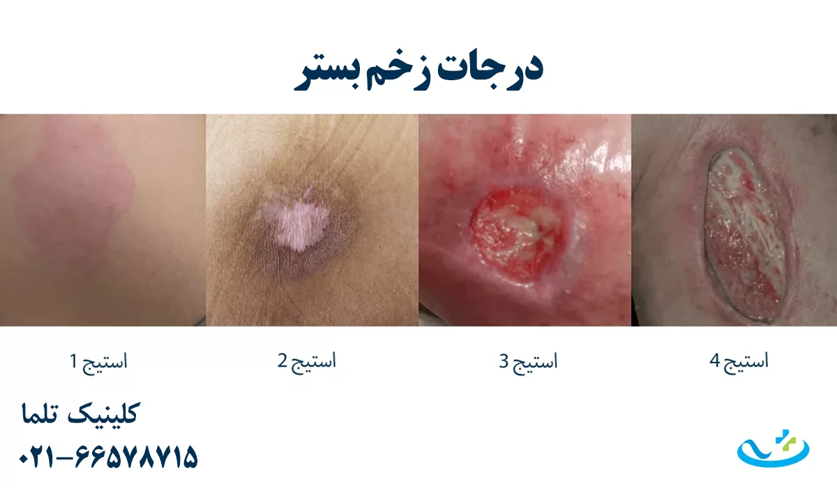 درجات زخم بستر
