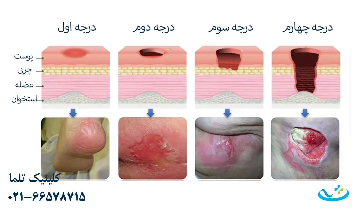 درحات زخم بستر