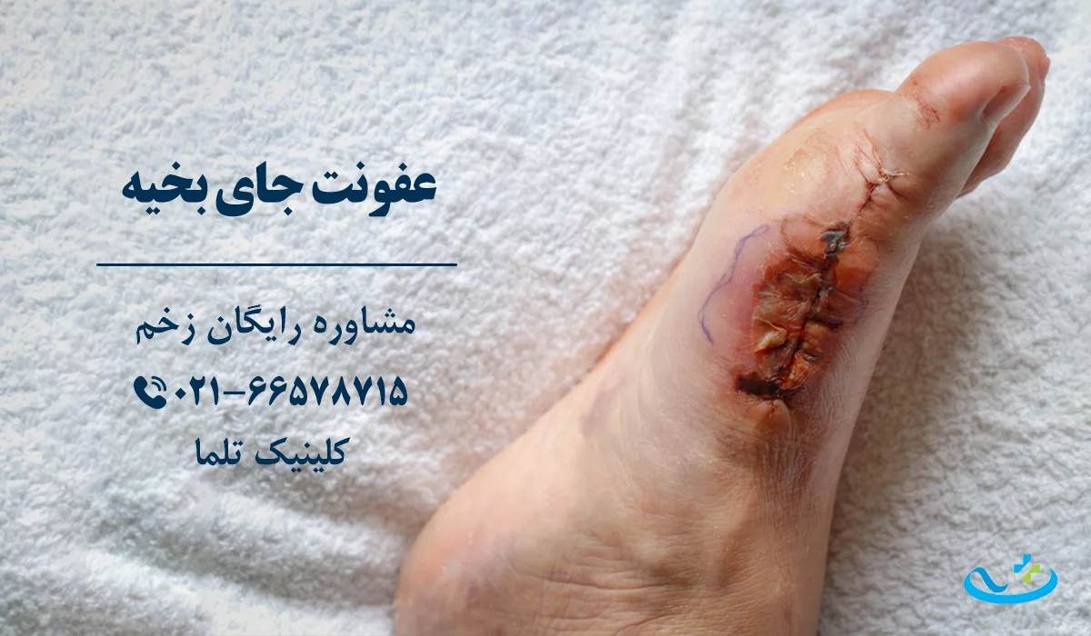 عفونت جای بخیه