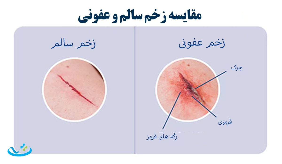 مقایسه زخم سالم و عفونی