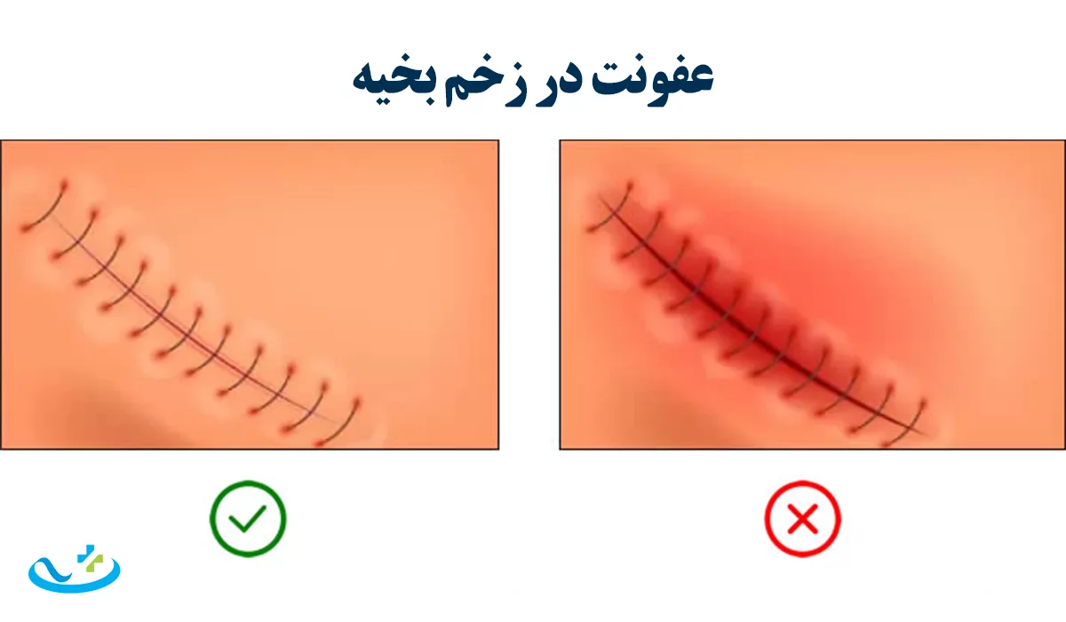 عفونت بخیه زخم
