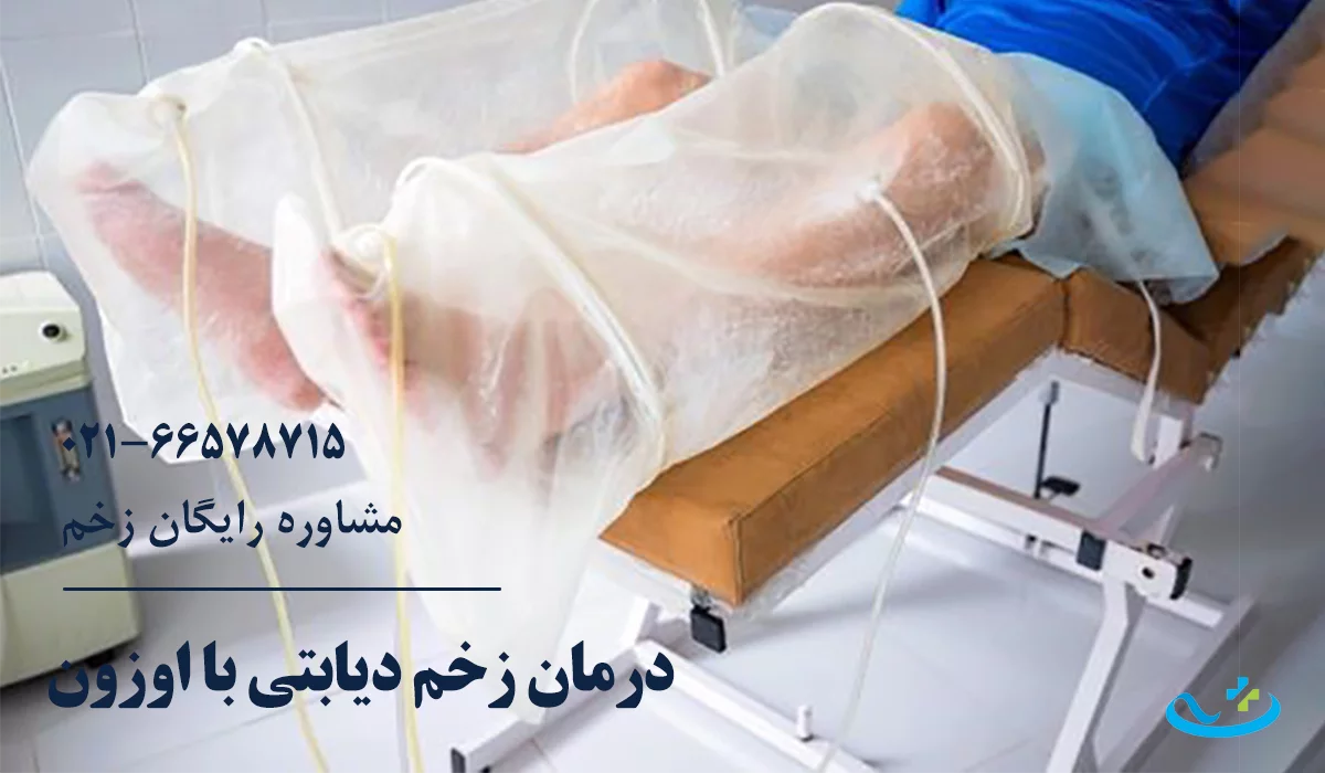 درمان زخم دیابتی با اوزون تراپی