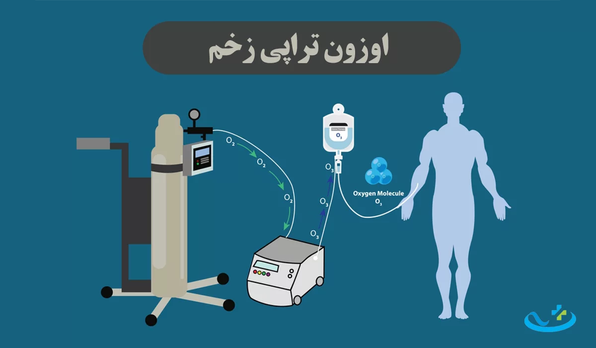 اوزون تراپی زخم