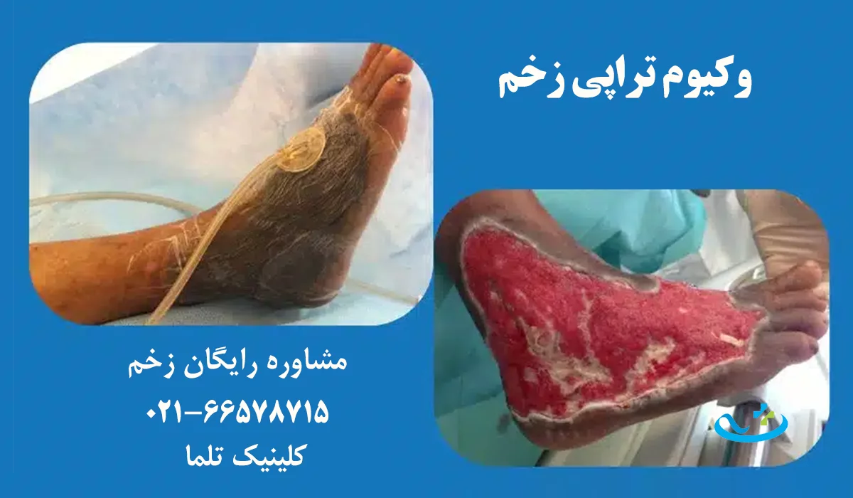 وکیوم تراپی زخم در تهران