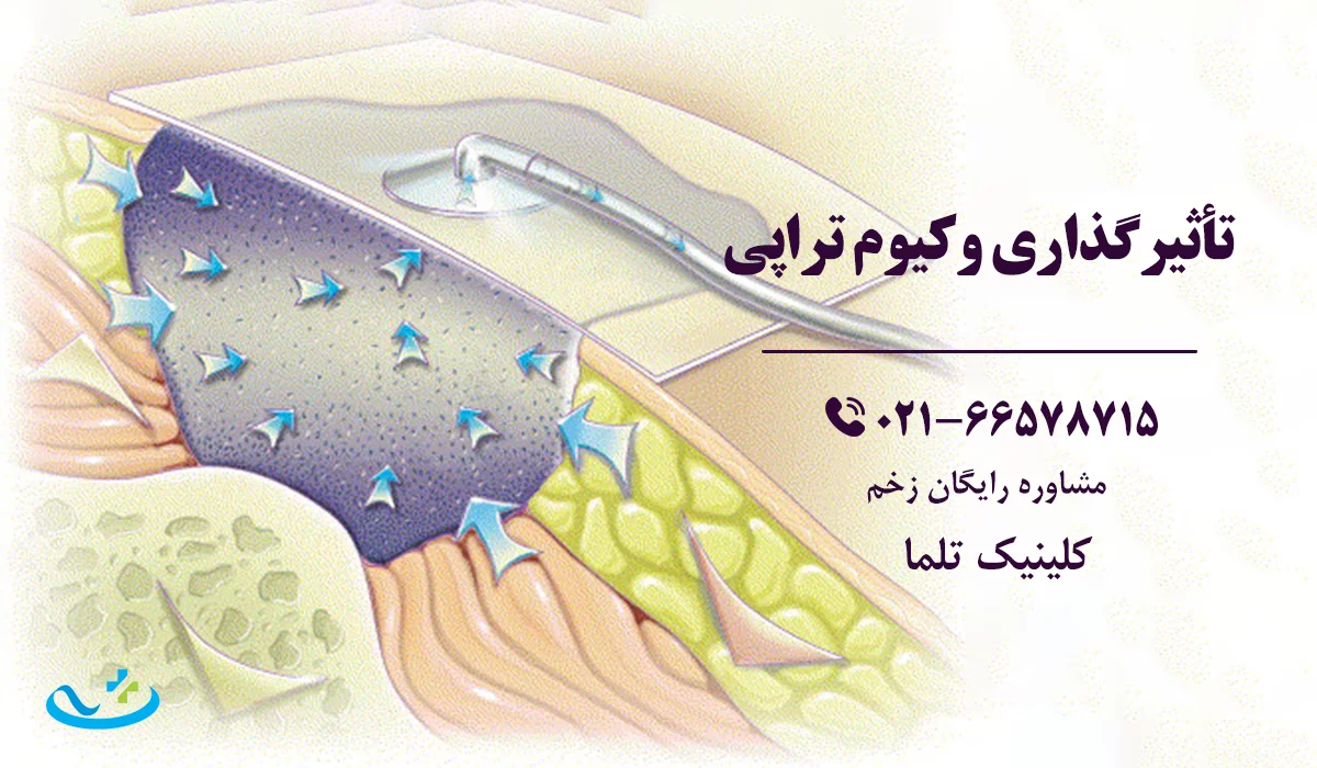 تأثیرگذاری وکیوم تراپی زخم