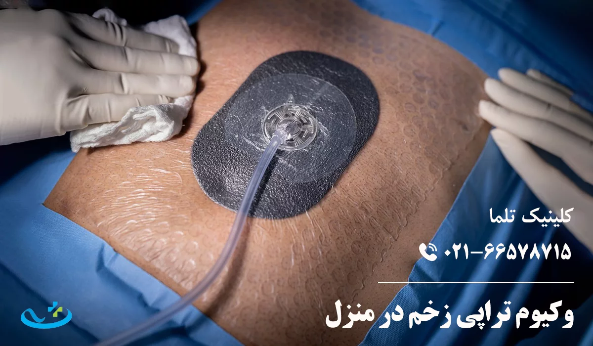 وکیوم تراپی زخم در منزل