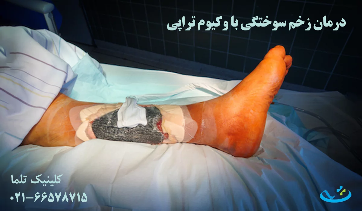 درمان زخم سوختگی با وکیوم تراپی