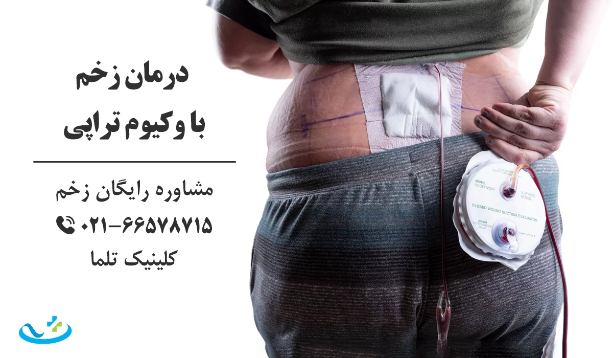 درمان زخم با وکیوم تراپی