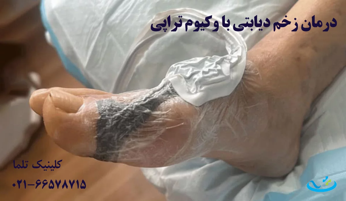 وکیوم تراپی زخم پای دیابتی