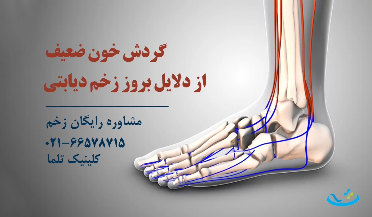 گردش خون در پای دیابتی