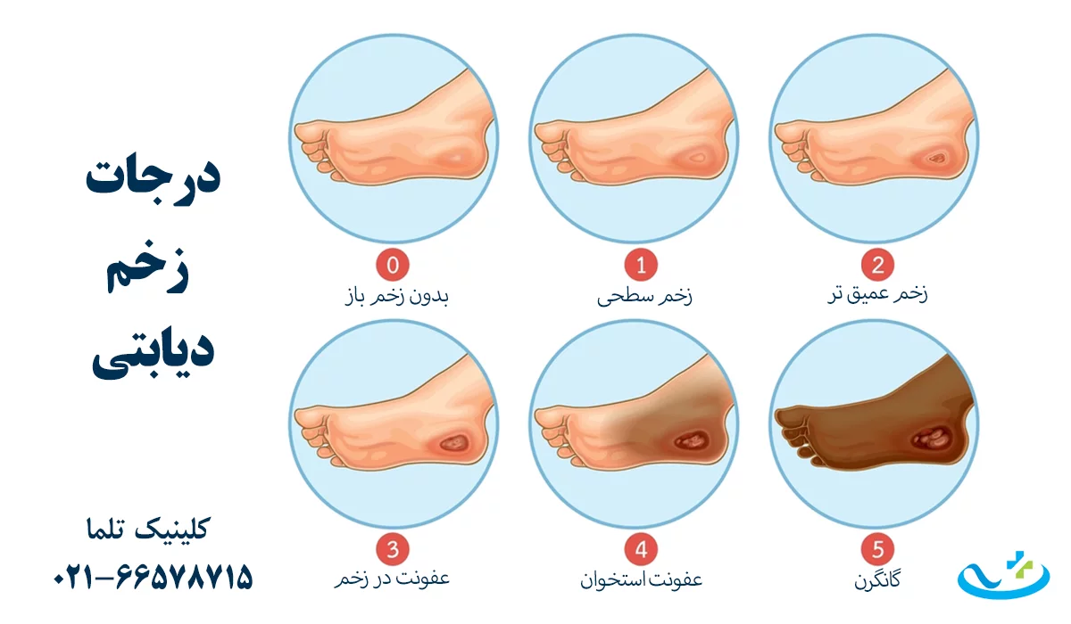 درجات زخم دیابتی