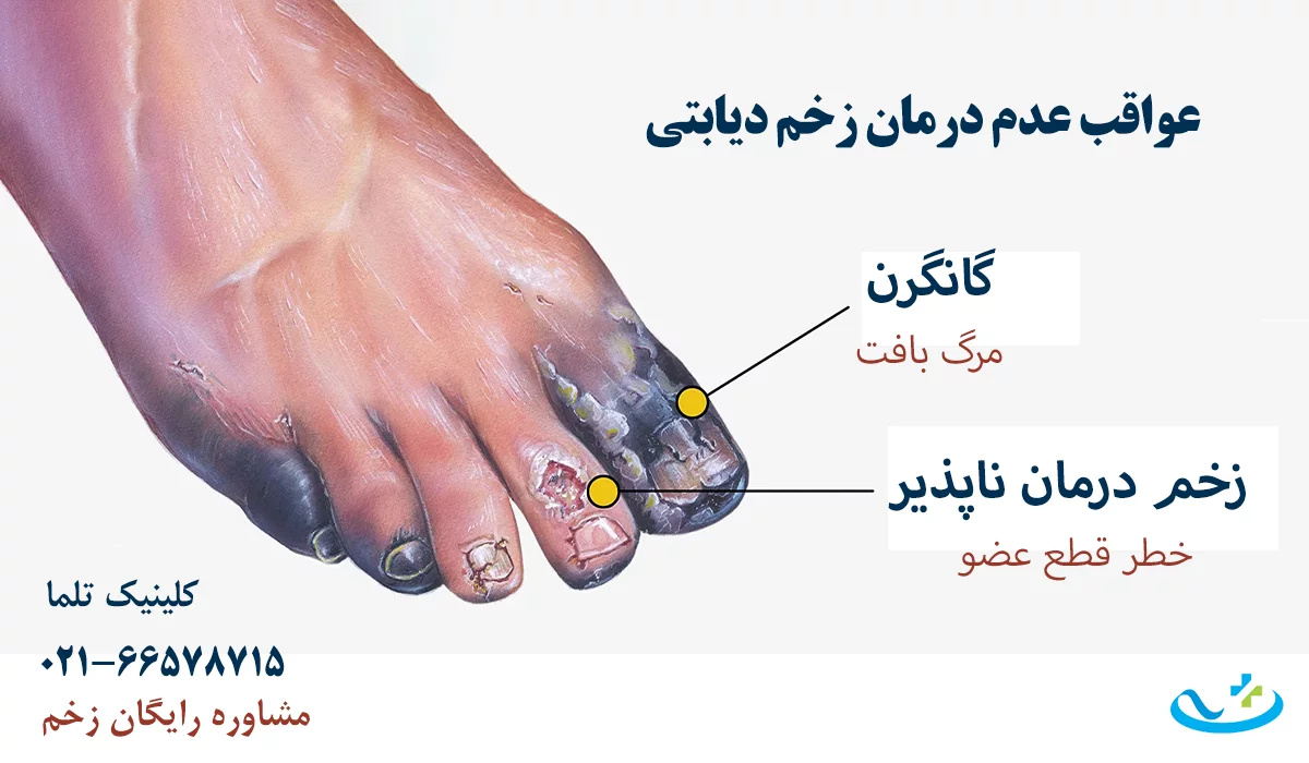 عواقب درمان زخم دیابتی در کلینیک