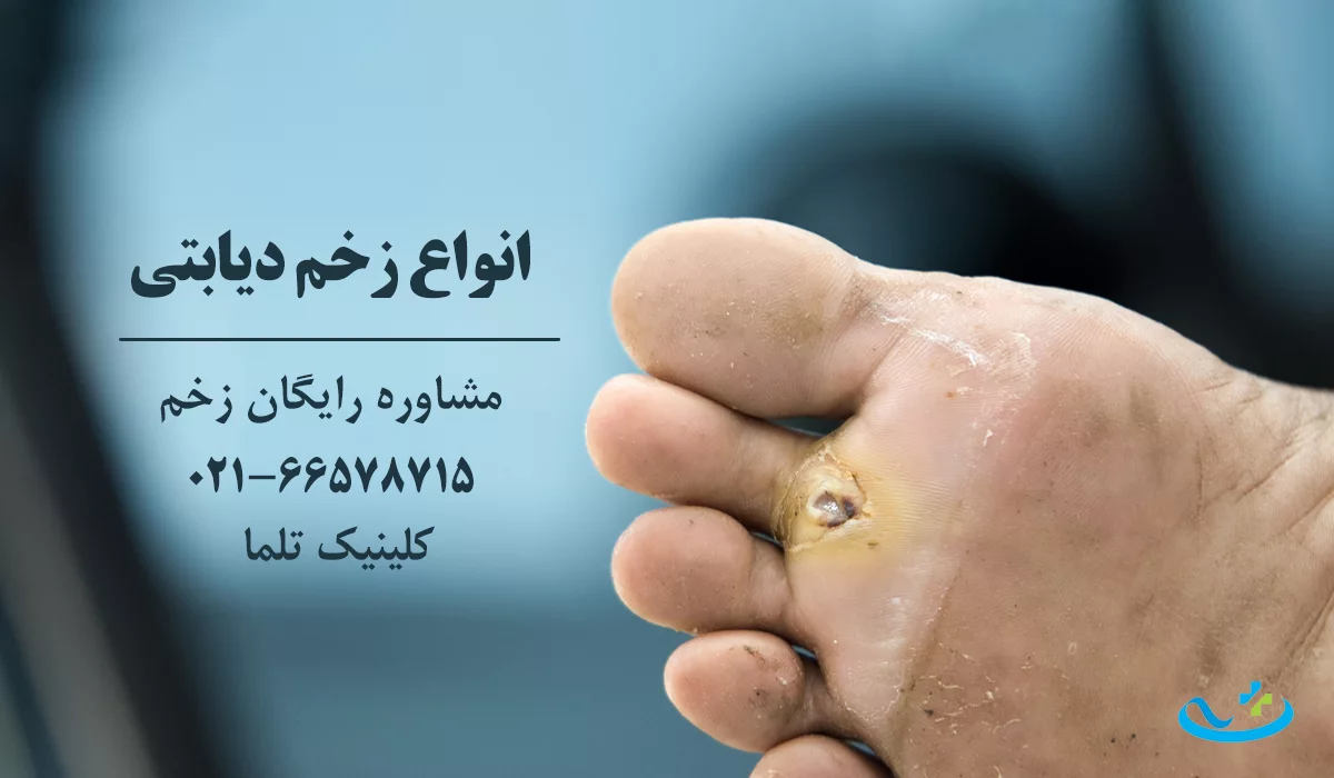انواع زخم دیابتی