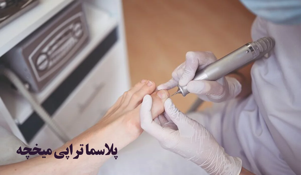 پلاسماتراپی میخچه