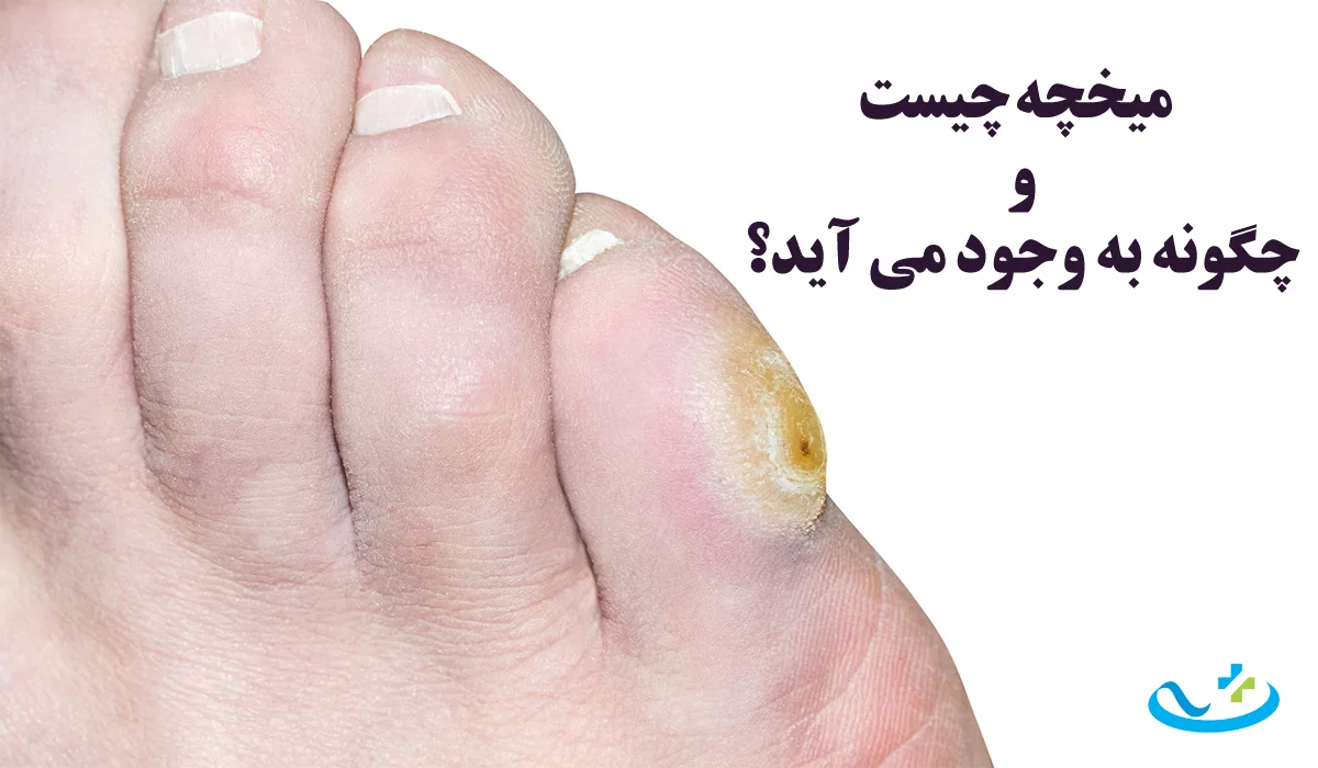 میخچه چیست