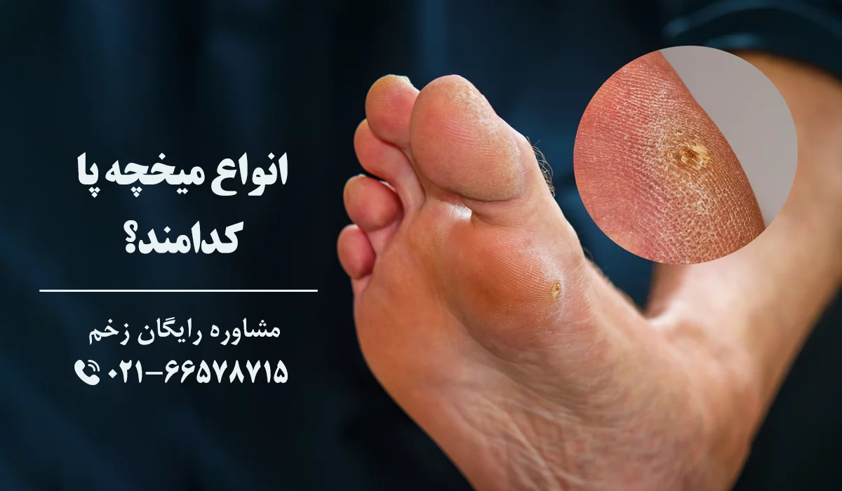 انواع میخچه پا
