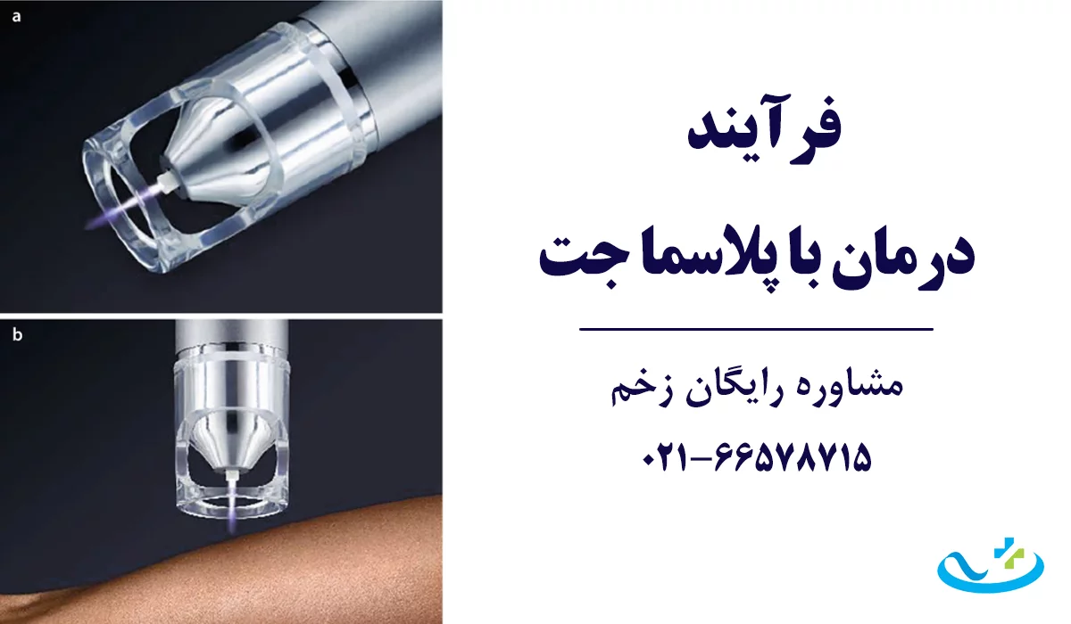 فرآیند درمان با پلاسما جت