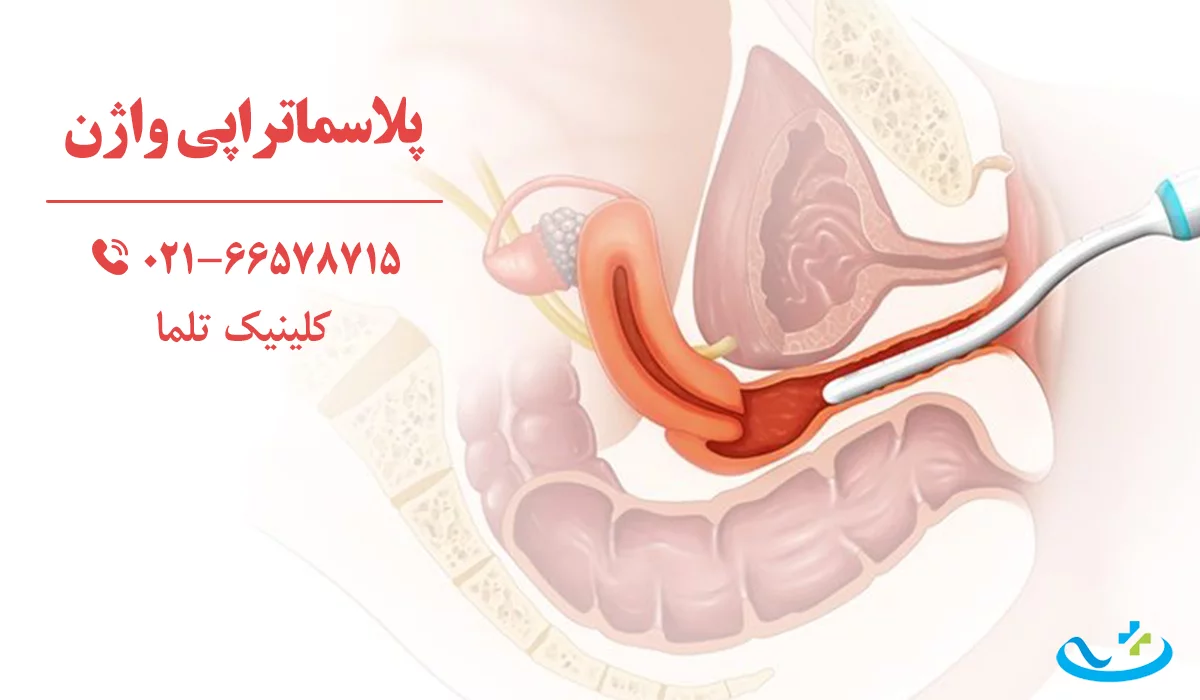پلاسماتراپی واژن