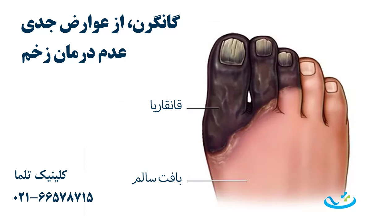 گانگرن