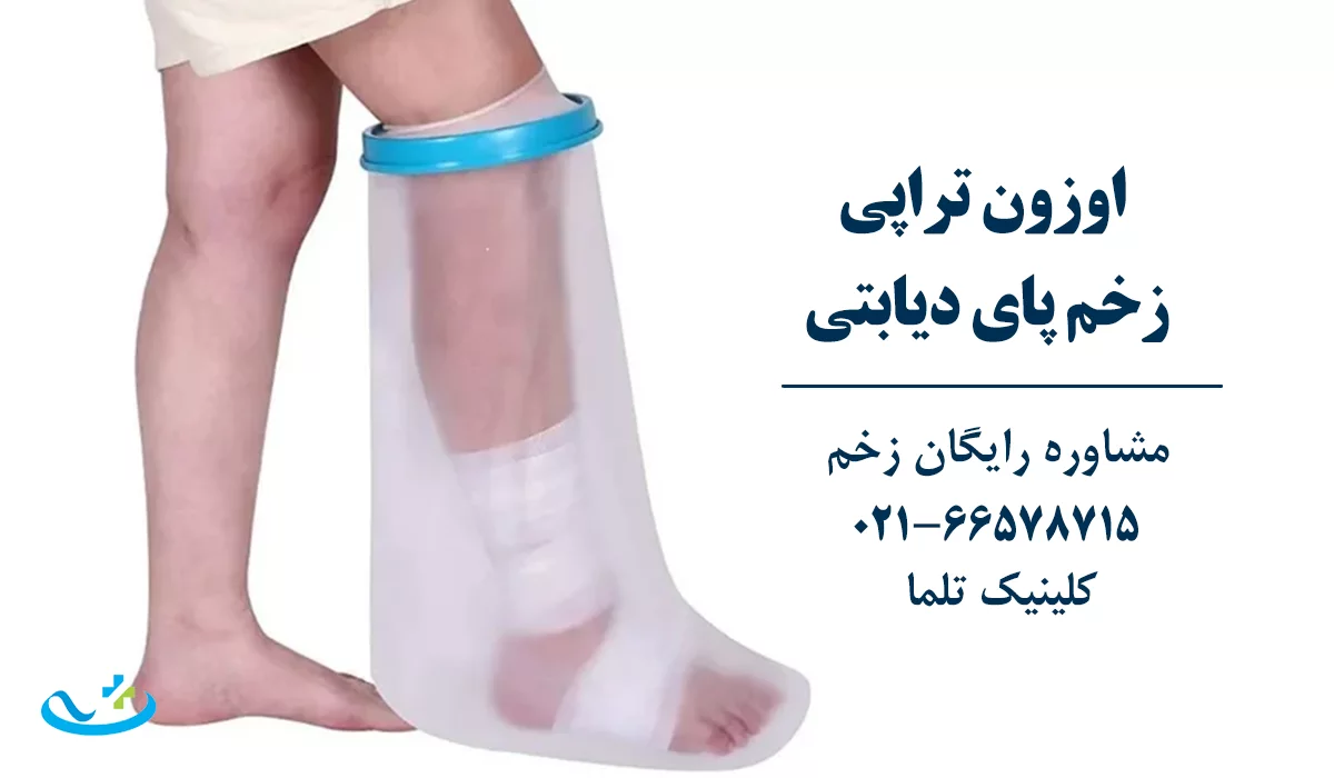 اوزون تراپی زخم دیابتی