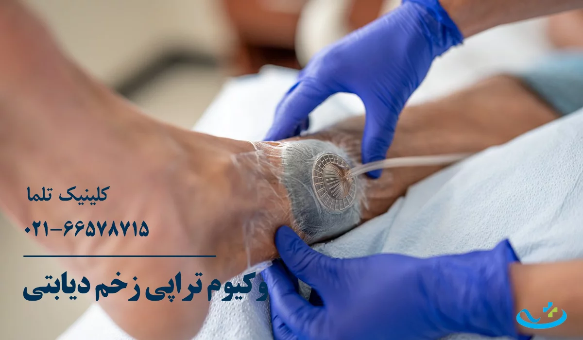 وکیوم تراپی زخم دیابتی