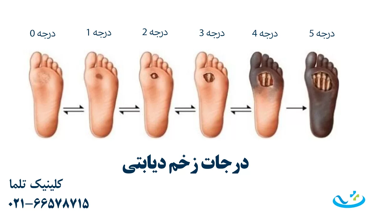 درجات زخم دیابتی