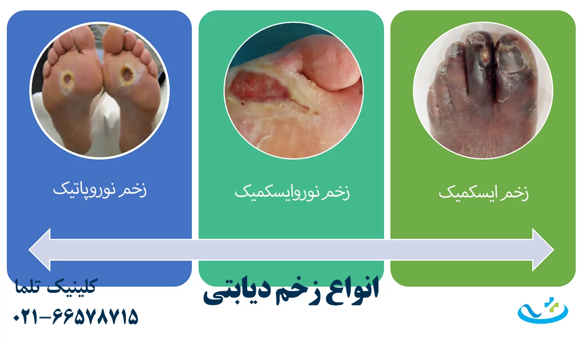 انواع زخم دیابتی