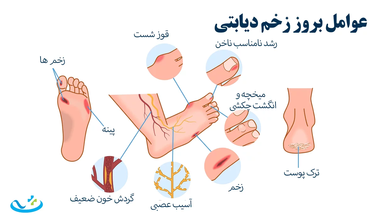 عوامل بروز زخم دیابتی