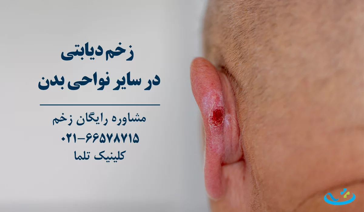 درمان زخم دیابتی