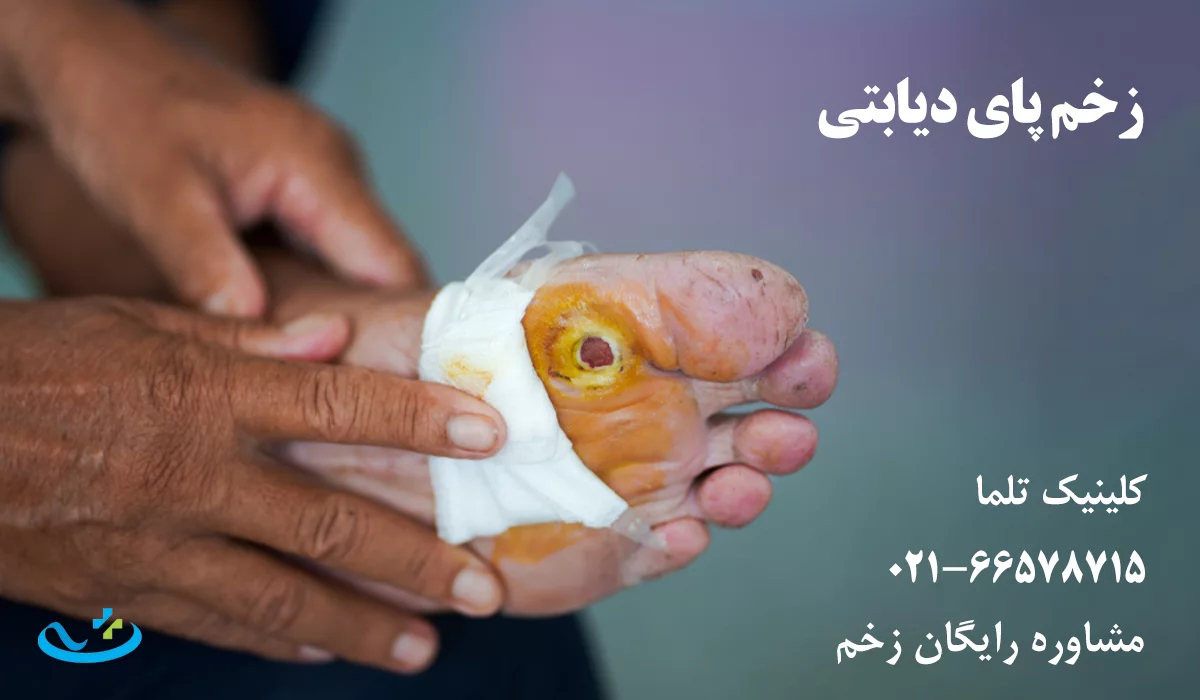 زخم پای دیابتی
