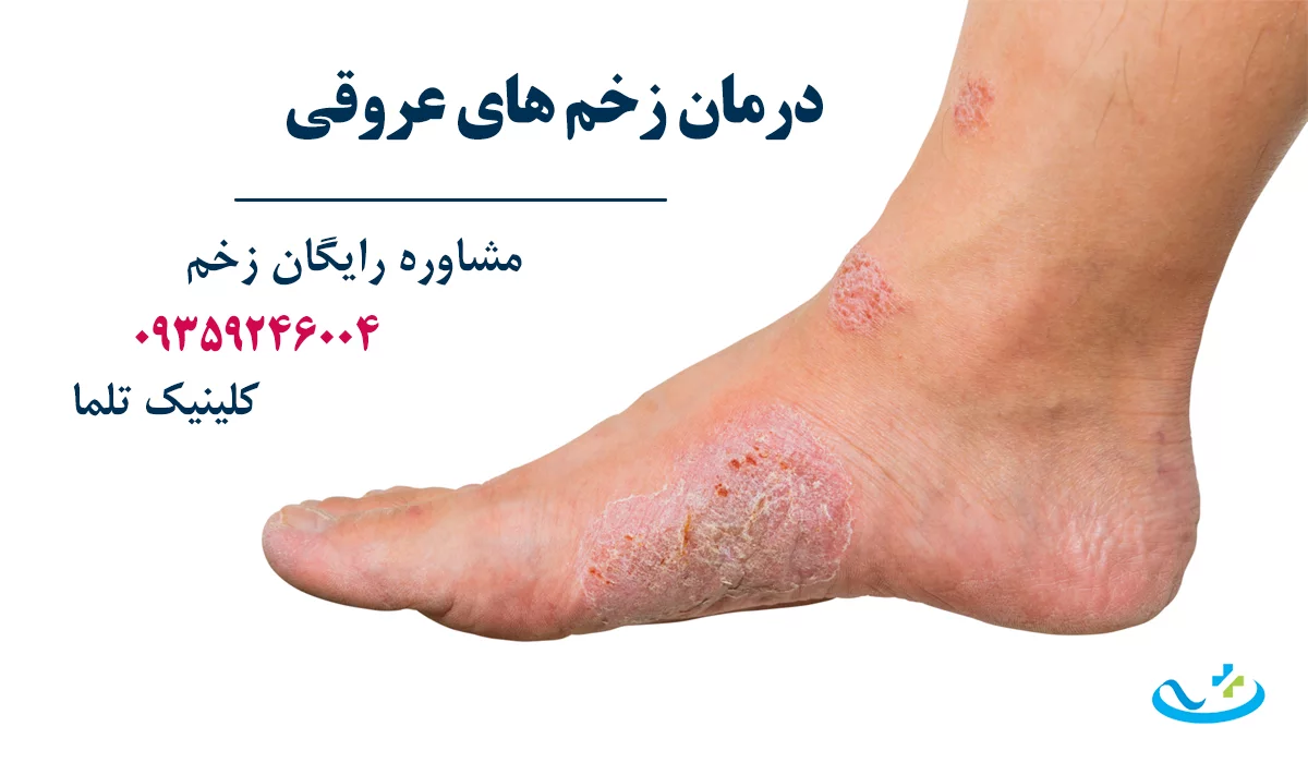 بهترین دکتر زخم تهران زخم های عروقی