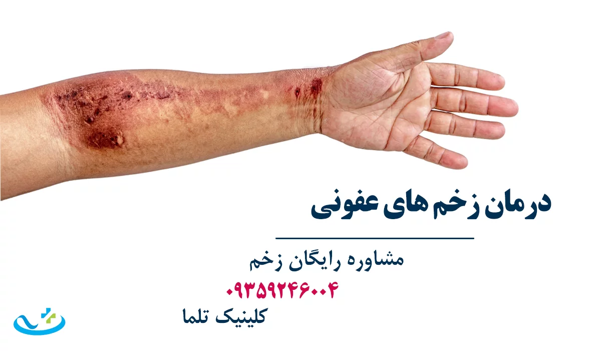 بهترین دکتر زخم تهران زخم های عفونی