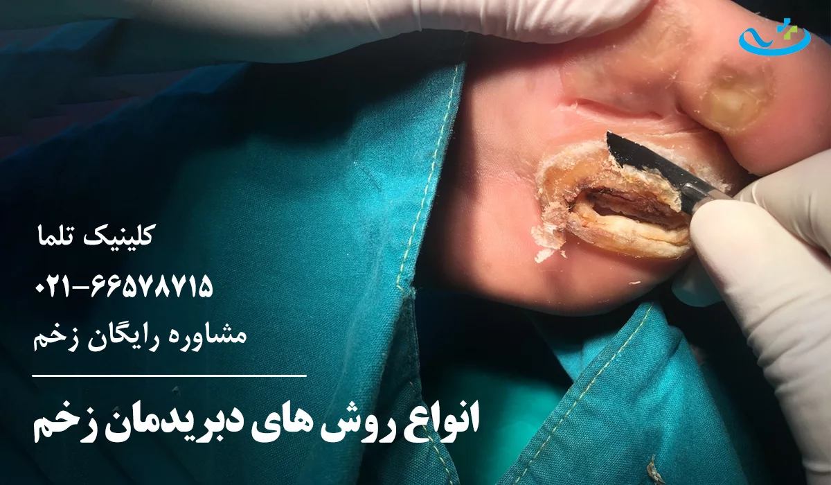 انواع دبریدمان