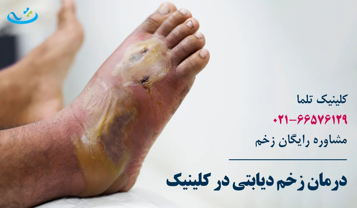 درمان در کلینیک زخم دیابتی تهران