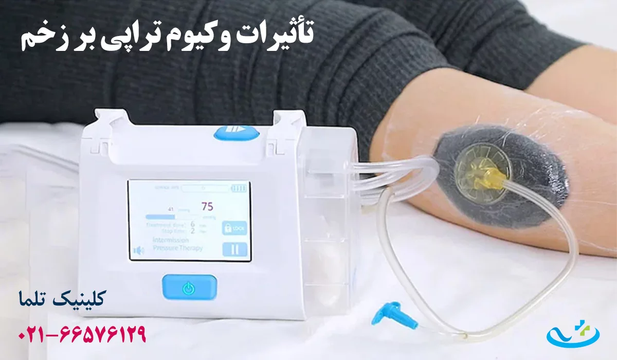 تأثیرات وکیوم تراپی زخم دیابتی