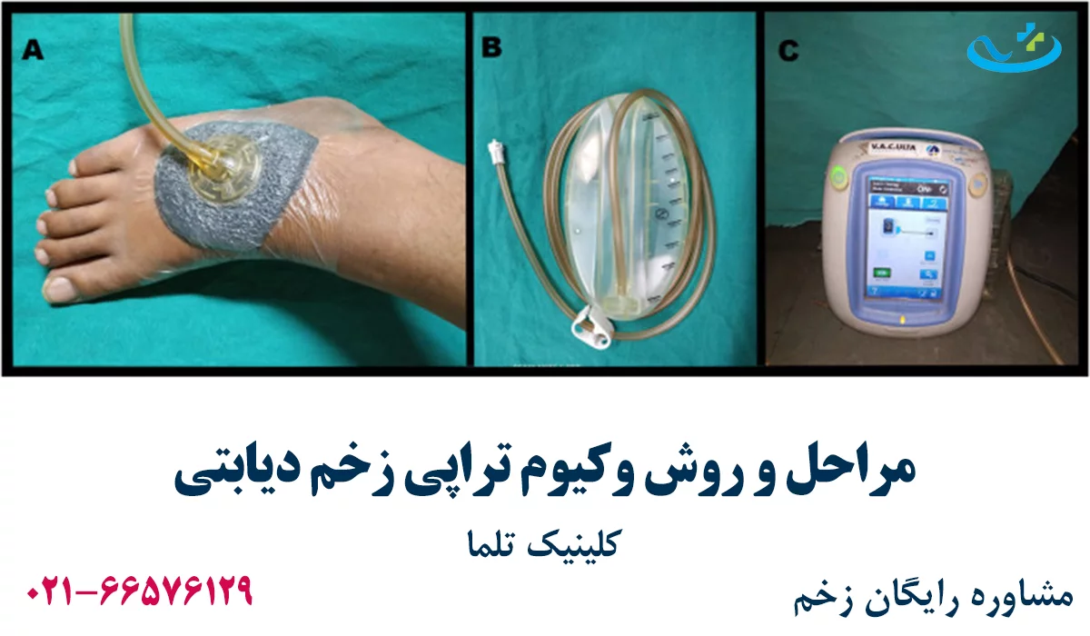 مراحل وکیوم تراپی زخم دیابتی