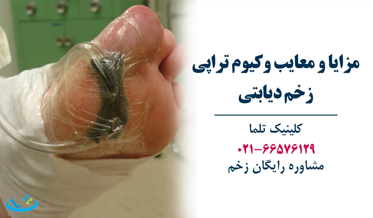 مزایا و معایب وکیوم تراپی زخم دیابتی