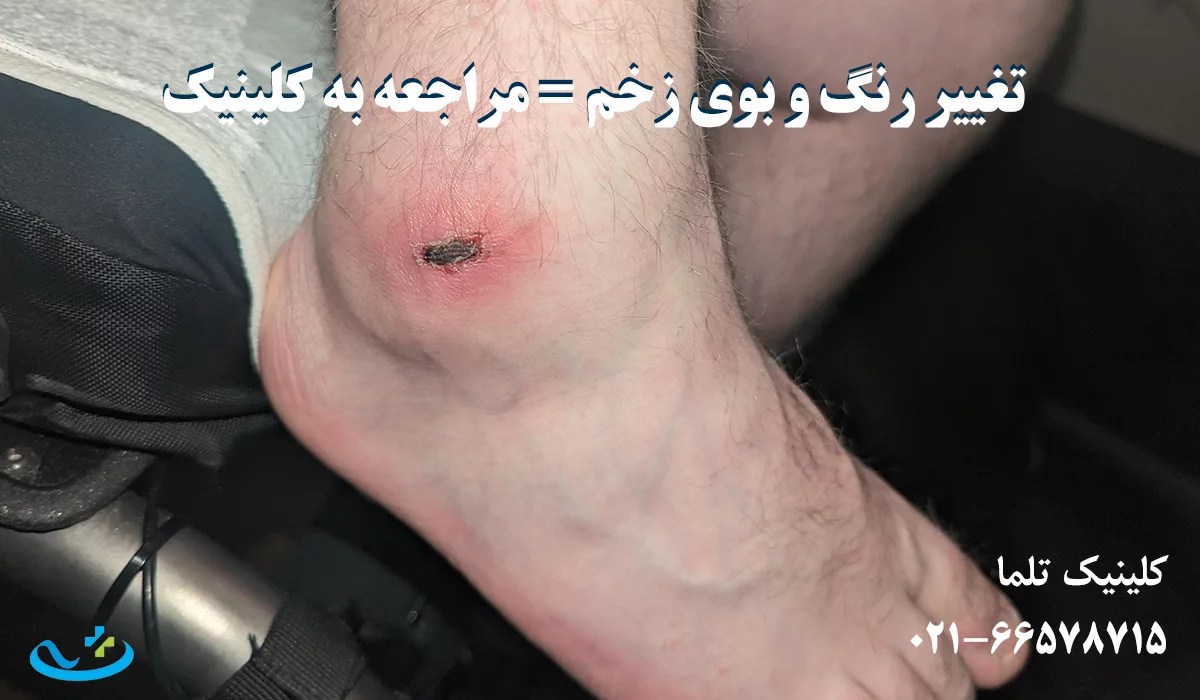 علائم نیاز به مراجعه فوری به کلینیک زخم