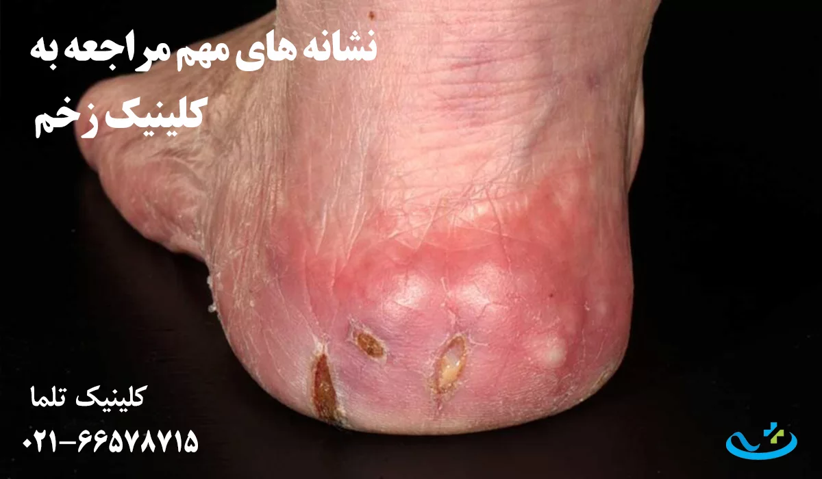 مراجعه فوری به کلینیک زخم