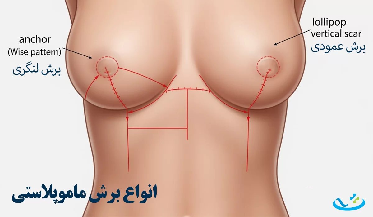 انواع برش ماموپلاستی