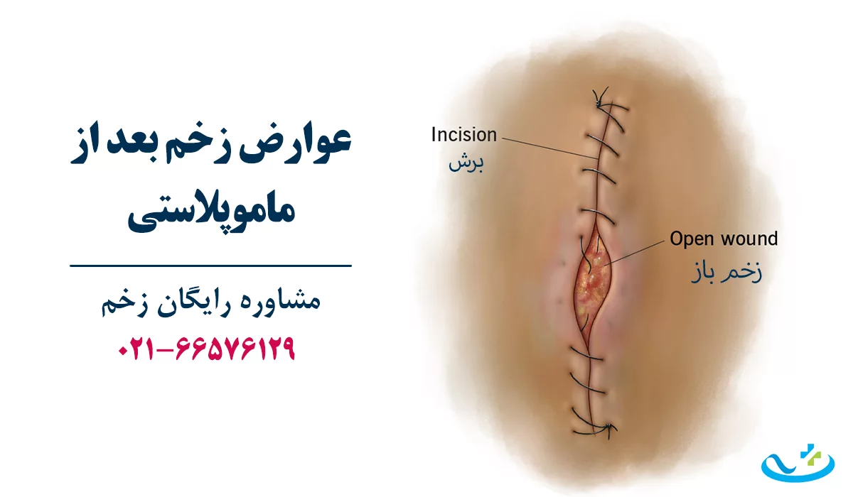 عوارض زخم بعد از ماموپلاستی