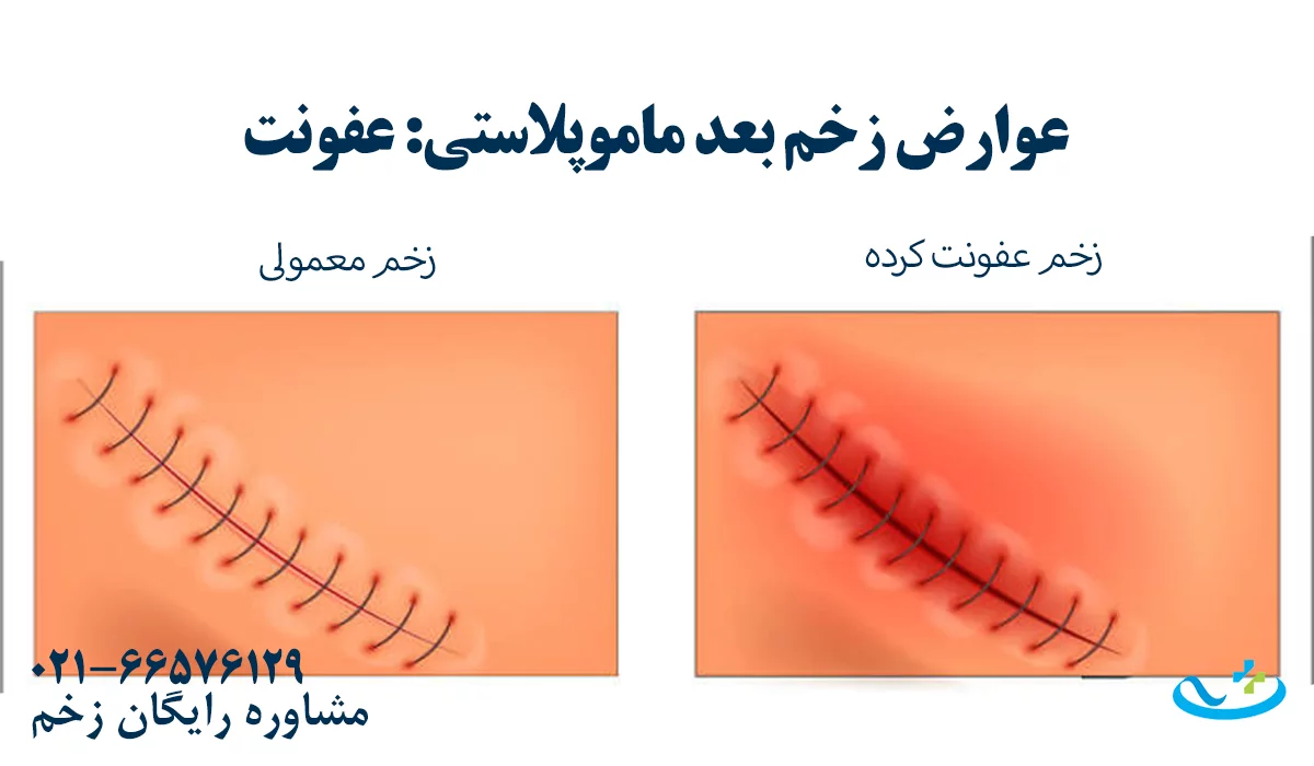 عوارض زخم بعد از ماموپلاستی